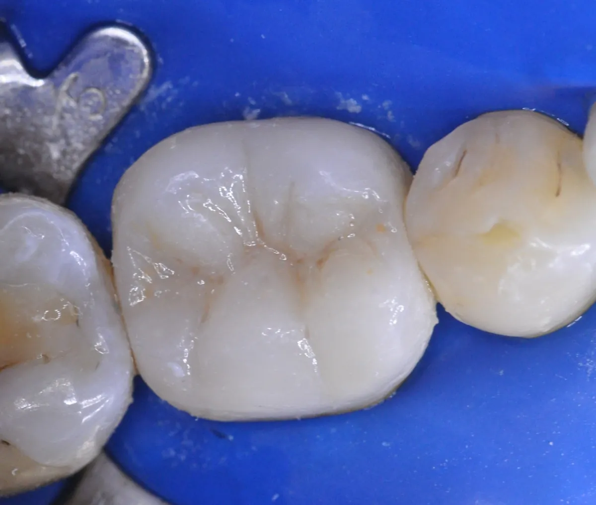 Fase 5: Corona en seis fases – Muelas desgastadas reconstruidas con coronas cerámicas, paso a paso