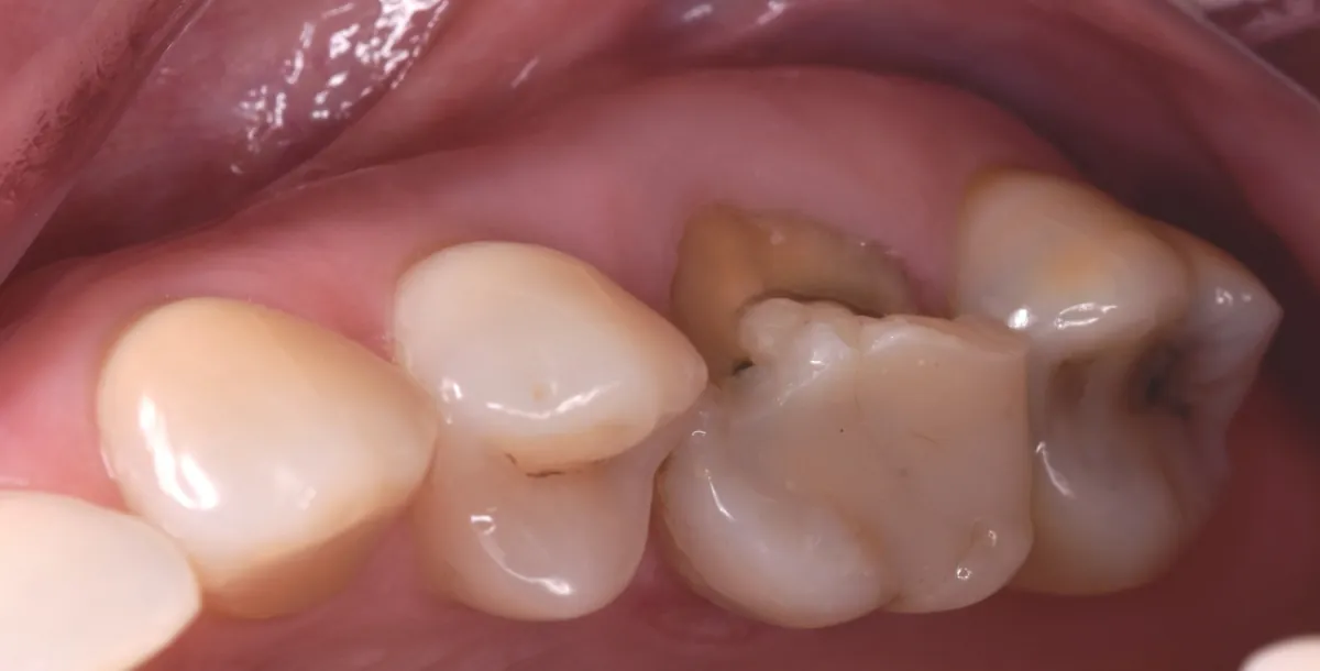 Antes: Implante inmediato — muela – Muela fracturada sustituida por una corona sobre implante