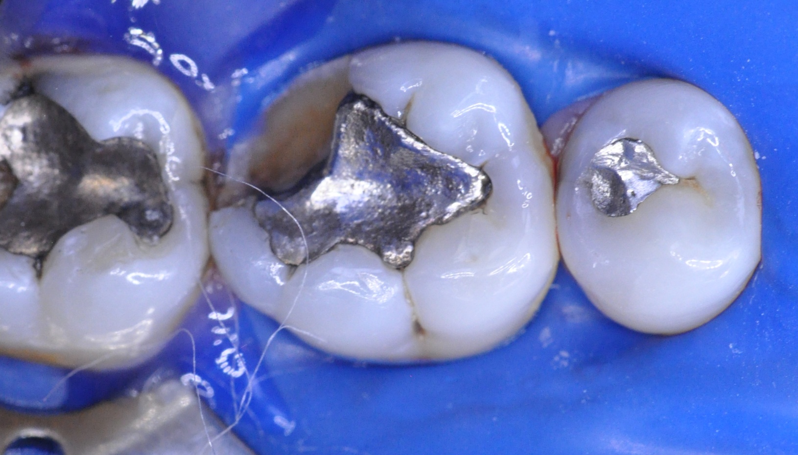 Before: Cavity filling