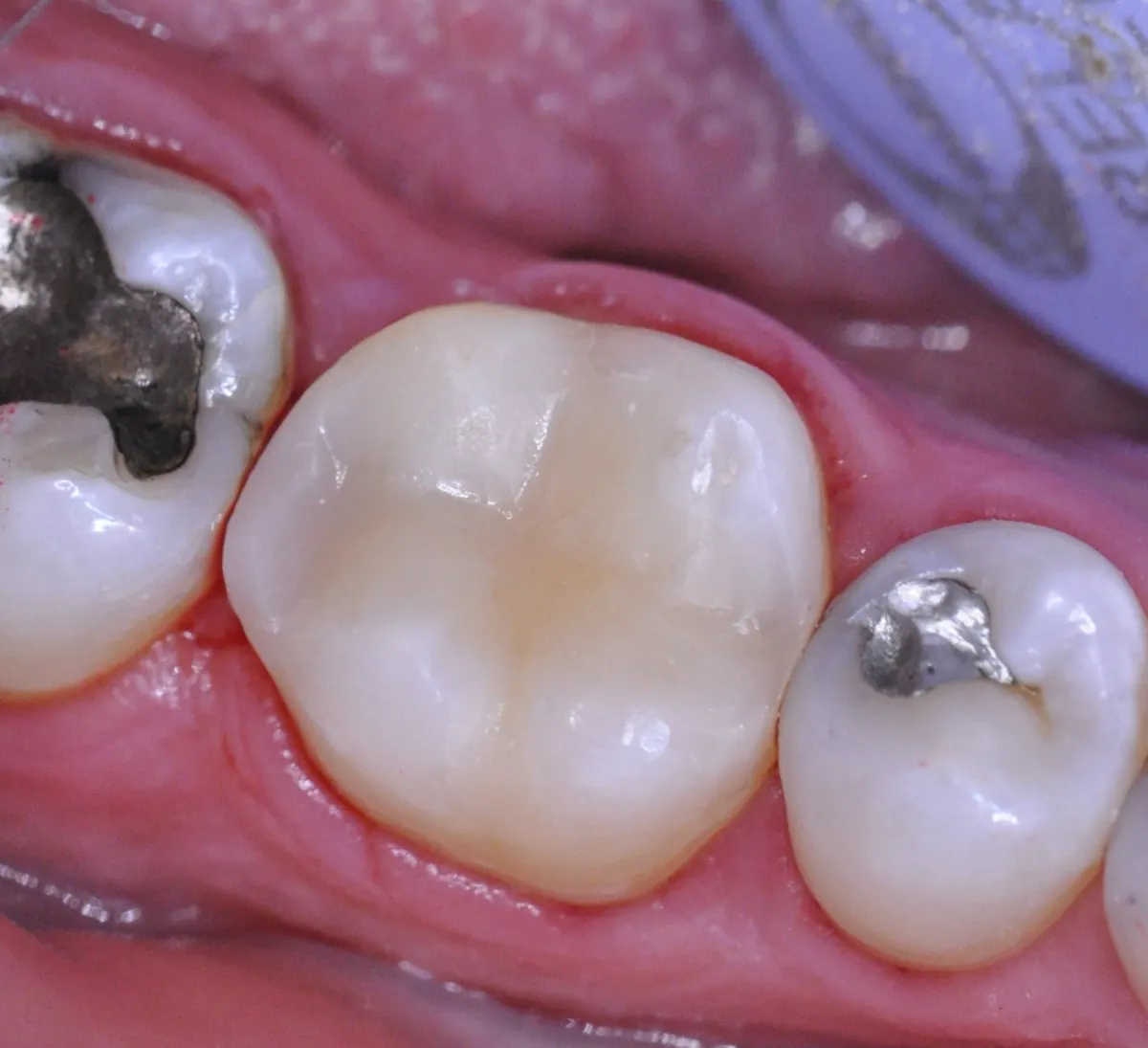 Después: Empaste de caries – Amalgama antigua sustituida por un empaste del color del diente