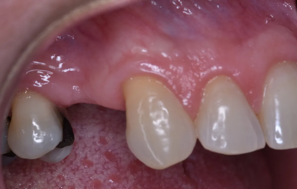 Antes: Implante dental – Restauración de una pieza ausente con corona sobre implante