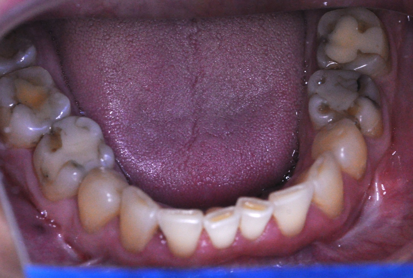 Phase 1: Crown in six phases
