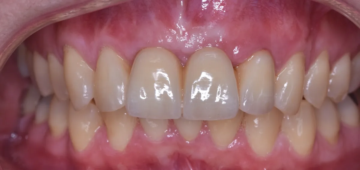 Después: Implantes múltiples – Tres piezas frontales ausentes sustituidas por implantes