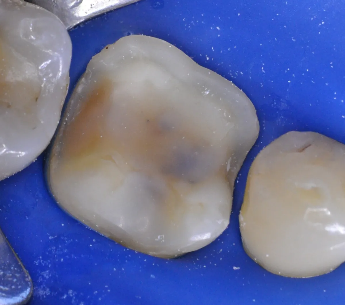 Fase 2: Corona en seis fases – Muelas desgastadas reconstruidas con coronas cerámicas, paso a paso