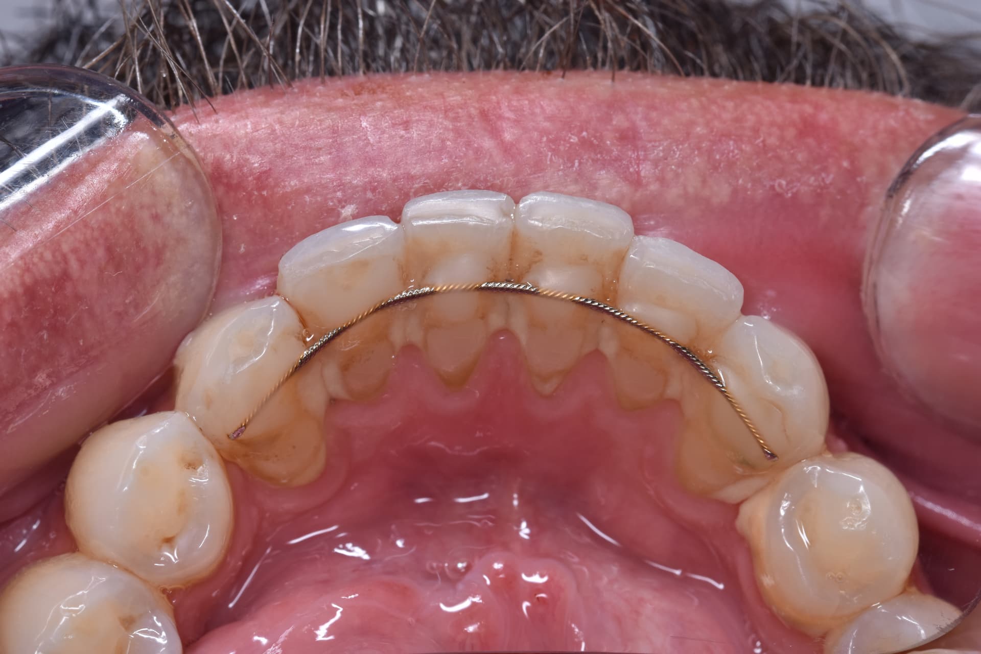 Before: Dental cleaning