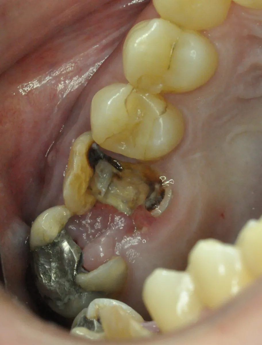Antes: Trasplante dental – Una pieza dañada sustituida por un diente trasplantado