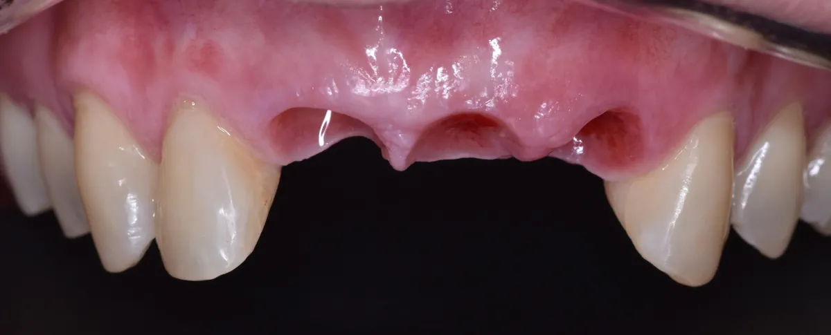 Fase intermedia: Implantes múltiples – Tres piezas frontales ausentes sustituidas por implantes