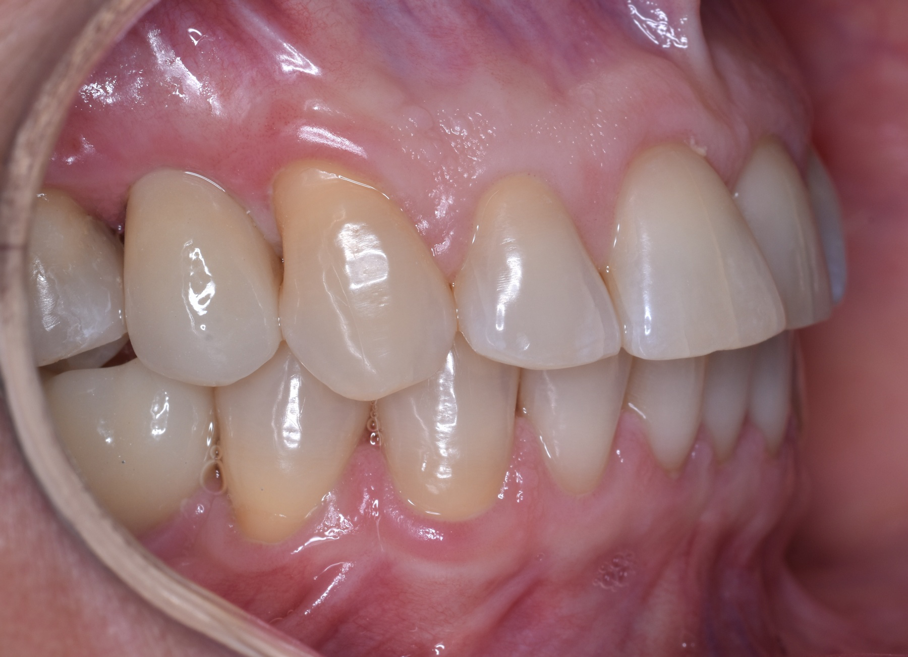 After: Dental implant