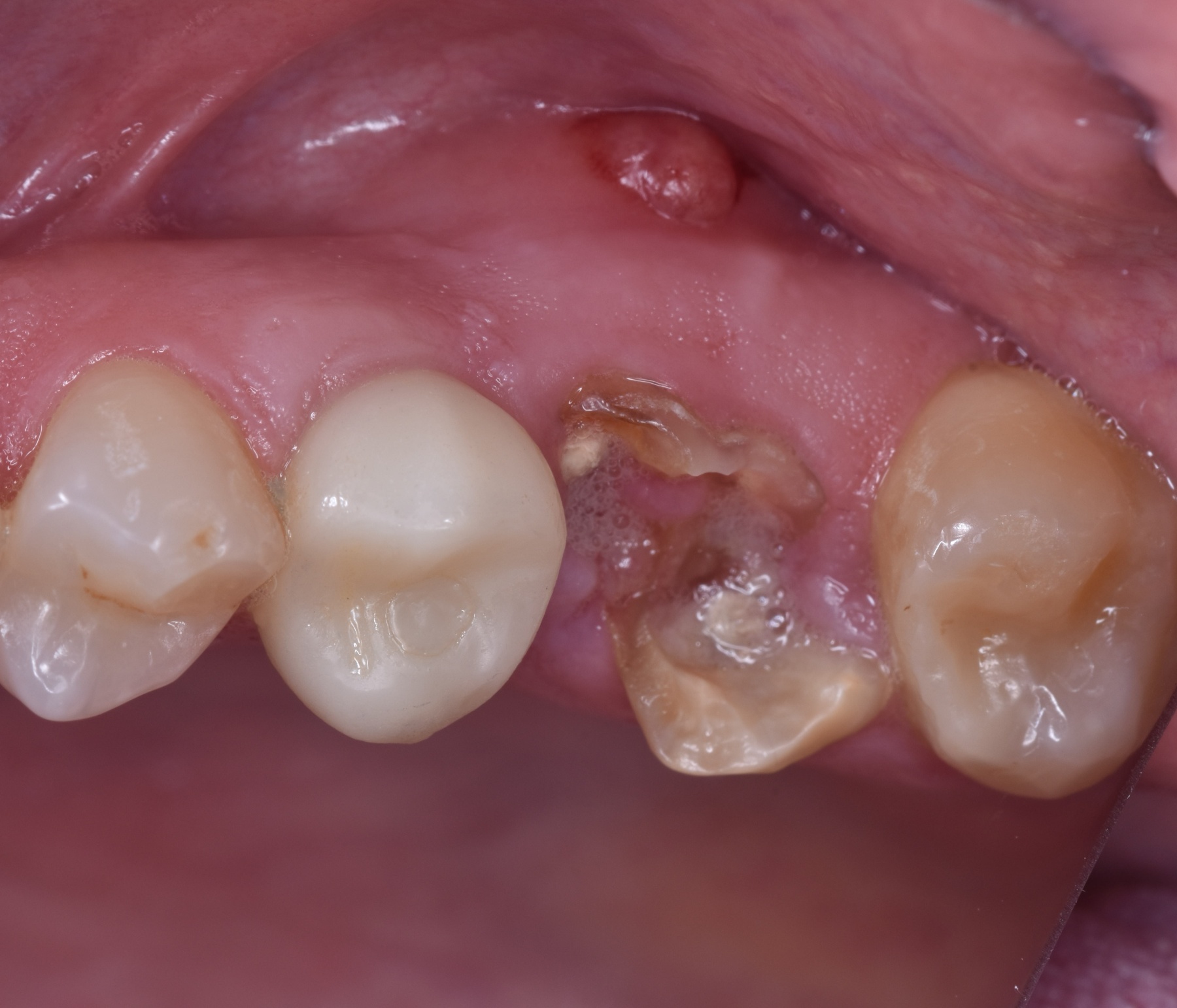 Before: Immediate implant