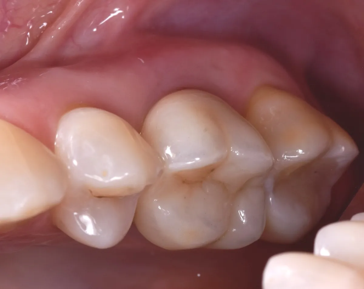 Después: Implante inmediato — muela – Muela fracturada sustituida por una corona sobre implante