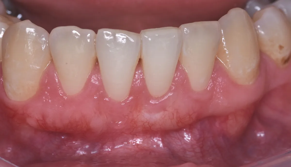Después: Recubrimiento radicular – Cirugía de encías para cubrir una raíz expuesta