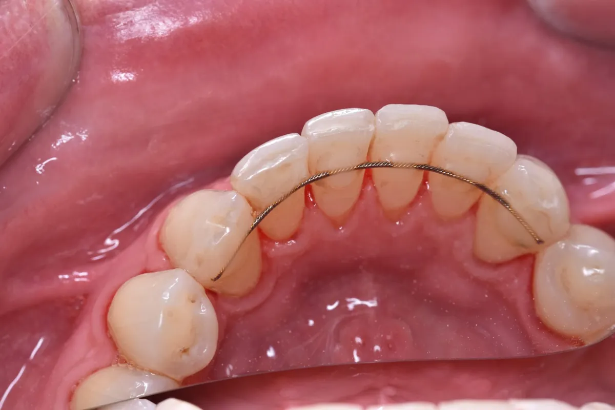 Después: Limpieza dental – Eliminación de placa y manchas