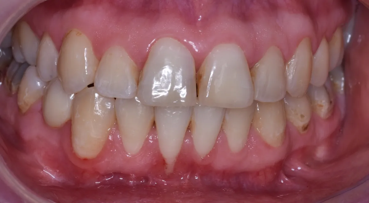 Antes: Recubrimiento radicular – Cirugía de encías para cubrir una raíz expuesta