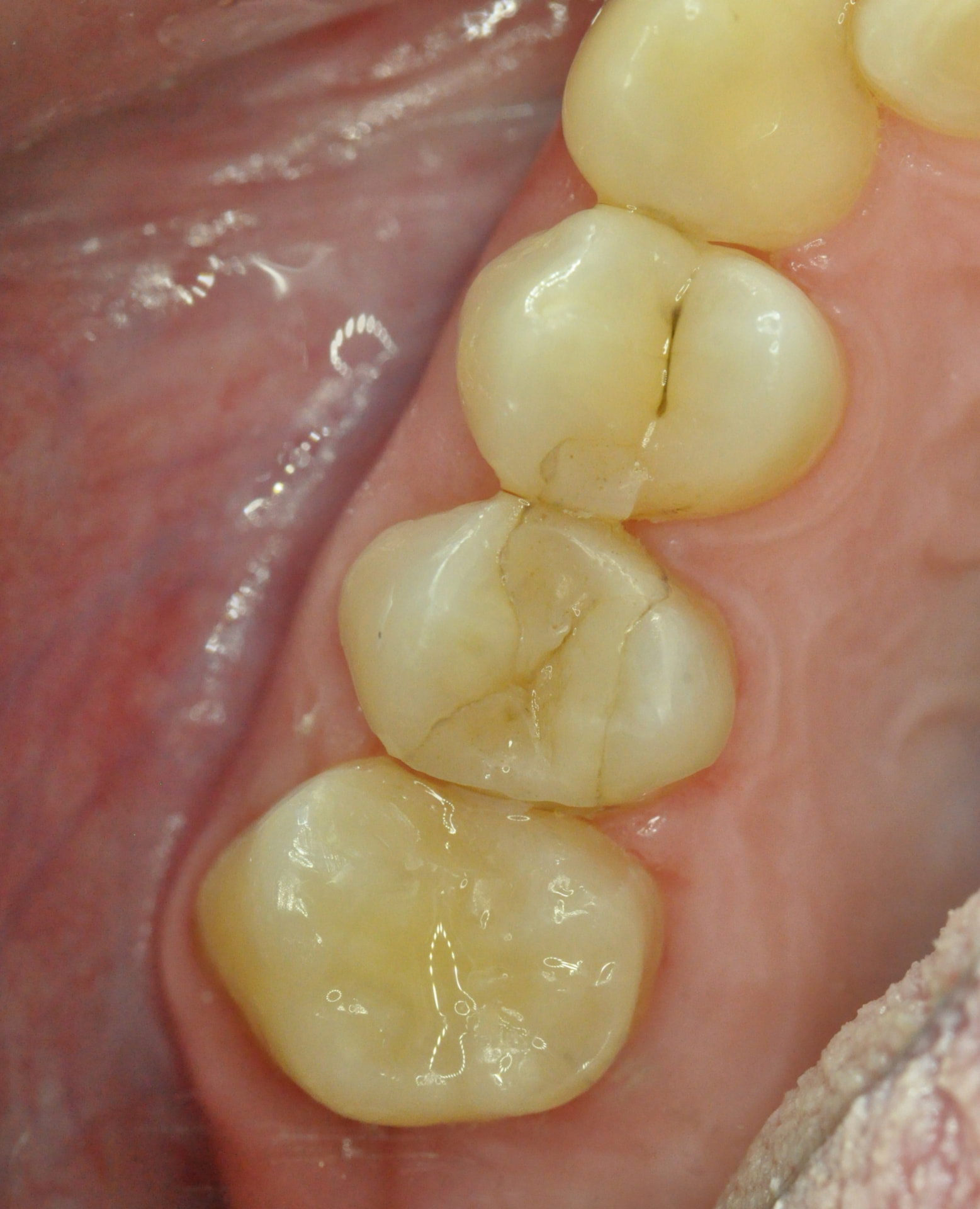 After: Tooth transplant