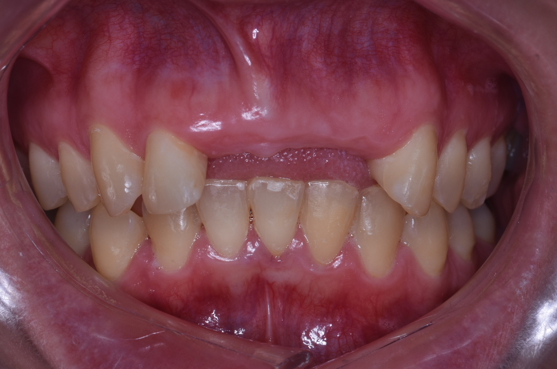 Before: Multiple implants
